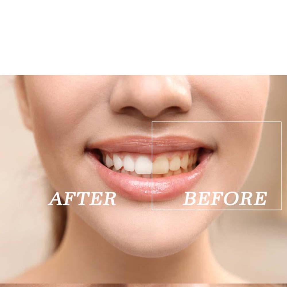 En kaliteli peroksit diş beyaz - Teeth Whitening/Bleaching incelemesi ve fiyatı