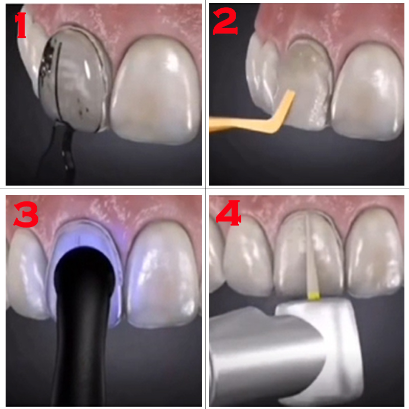 Otoklavlanabilir Ön Diş Esteti - Teeth Whitening Moulds incelemesi ve fiyatı